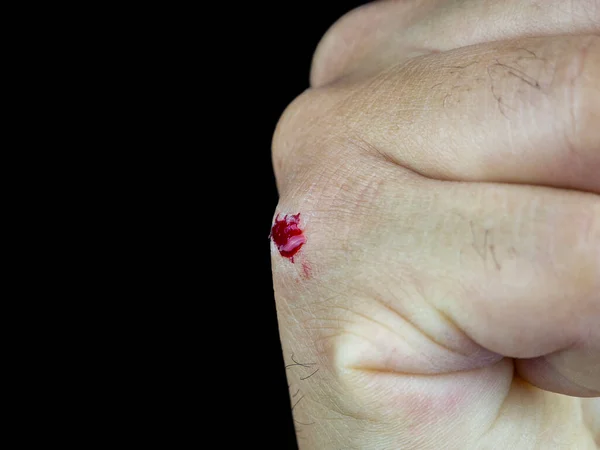 Unfall Offene Schürfwunden Trauma Haut Hand Menschen Gesundheitswesen Und Medizinkonzept — Stockfoto