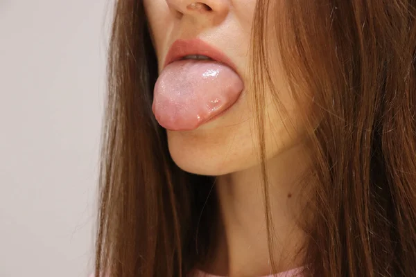 Woman shows large swollen tongue. Allergic reaction with Quinckes edema or Gastroesophageal reflux disease