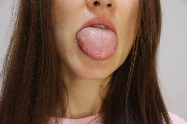 Quinckes水肿或过敏后舌肿胀的年轻妇女 — 图库照片