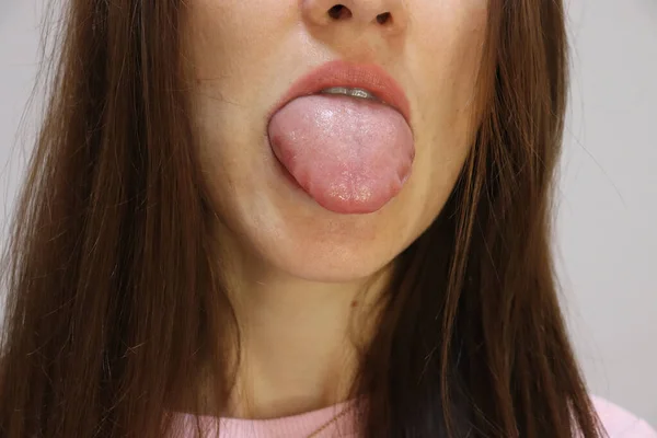 Mujer Joven Que Muestra Lengua Hinchada Después Quinckes Edema Alergia —  Fotos de Stock