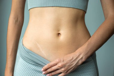 Bir kadının apandisit ameliyatı sonrası karın bölgesi yara izi, ameliyatın sonuçları.