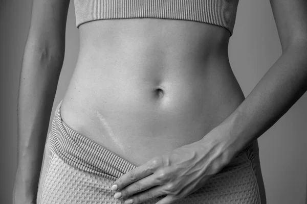 Black White Photo Appendicitis Scar Young Athletic Woman — Stock Photo, Image