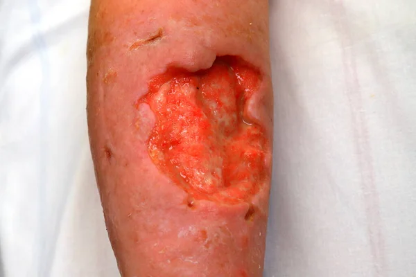 Úlcera Trófica Grande Profunda Perna Defeito Pele Tecidos Moles Complicações — Fotografia de Stock