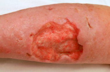 Bacağının alt kısmındaki varis damarlarında komplikasyonlar. Bacağında derin trofik ülser, cilt hasarı ve yumuşak dokular. Ağlama yarası, egzama, deri iltihabı. Şiddetli tıbbi hastalık