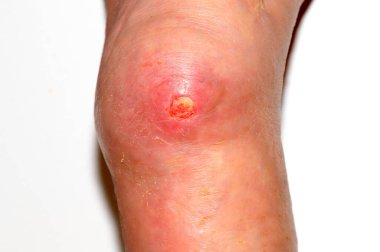 Bacağında derin trofik ülser, cilt hasarı ve yumuşak dokular. Bacağının alt kısmındaki varis damarlarında komplikasyonlar, ağlayan hatıra yarası, egzama, dermatit. şiddetli tıbbi hastalık