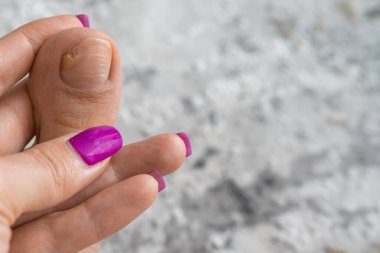 Ayaklar yakın, mantar, tırnak kırığı, deri enfeksiyonu, ayak parmağı enfeksiyonu, tedavi, mantar enfeksiyonu konsepti, onikomikoz, onikoliz, tırnak yatağından ayrılır, 