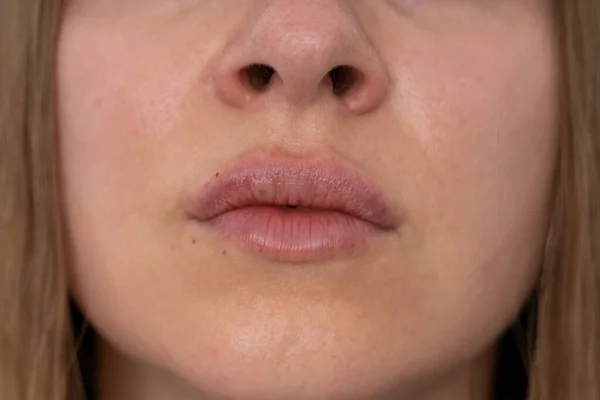 Usta Kobiety Wciskać Bliska Widok Zabiegu Powiększenia Warg Wypełniaczami Zwiększenie — Zdjęcie stockowe