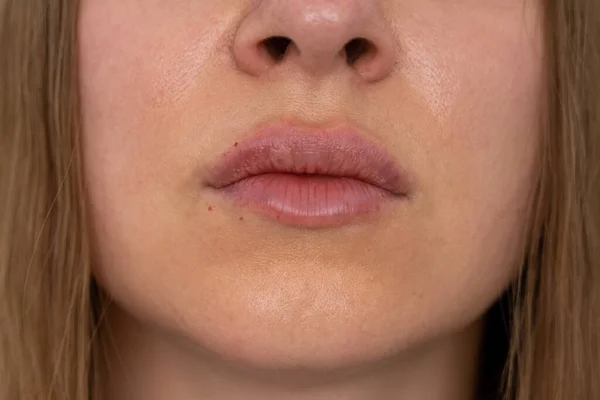 Γυναίκα Χείλη Push Προβολή Από Κοντά Μετά Από Διαδικασία Αύξησης — Φωτογραφία Αρχείου