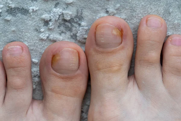 Πρόσωπο Πόδια Κοντά Μύκητας Σπασμένο Νύχι Λοίμωξη Του Δέρματος Μυκητίαση — Φωτογραφία Αρχείου