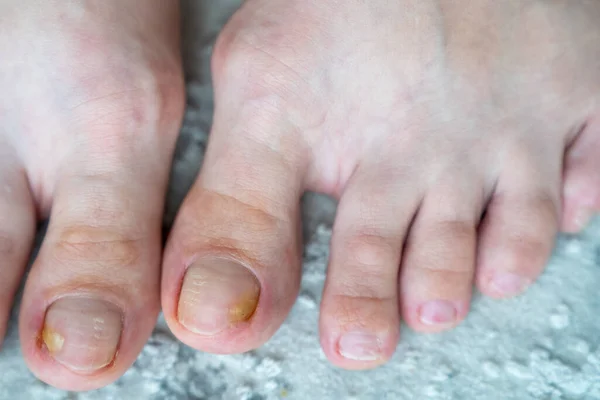 person feet close up, fungus, broken nail, skin infection, toe mycosis, treatment needed, fungal infection concept, onychomycosis, onycholysis, nail separates from nail bed, separated