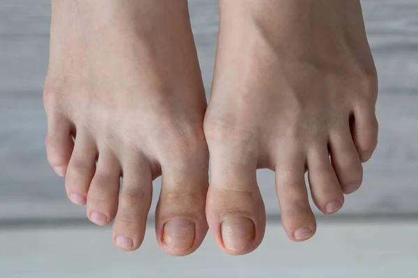 Person Feet Close Fungus Broken Nail Skin Infection Toe Mycosis — Stock Photo, Image