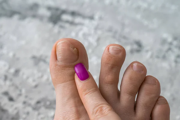 person feet close up, fungus, broken nail, skin infection, toe mycosis, treatment needed, fungal infection concept, onychomycosis, onycholysis, nail separates from nail bed, separated