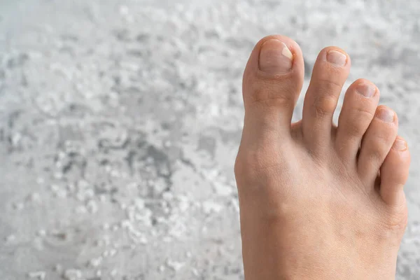 person feet close up, fungus, broken nail, skin infection, toe mycosis, treatment needed, fungal infection concept, onychomycosis, onycholysis, nail separates from nail bed, separated