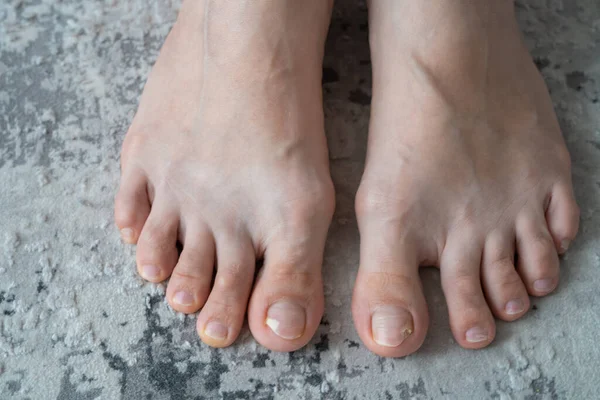 person feet close up, fungus, broken nail, skin infection, toe mycosis, treatment needed, fungal infection concept, onychomycosis, onycholysis, nail separates from nail bed, separated