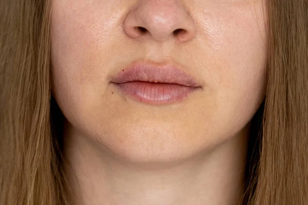 Vrouw Lippen Duwen Van Dichtbij Bekijken Lip Augmentatie Procedure Met — Stockfoto