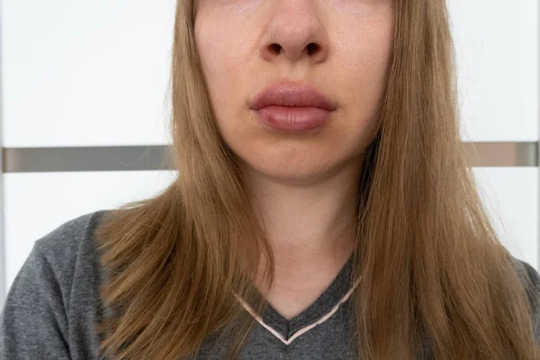 여성의 입술은 살균자 입술의 과정을 가까이 수정체를 증가시키고 자국이 보이는 — 스톡 사진