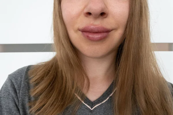 woman lips close up view after lip augmentation procedure with fillers, increase lips hyaluronic acid, visible place of needle injection marks, swelling after cosmetic procedure, cosmetician treatment