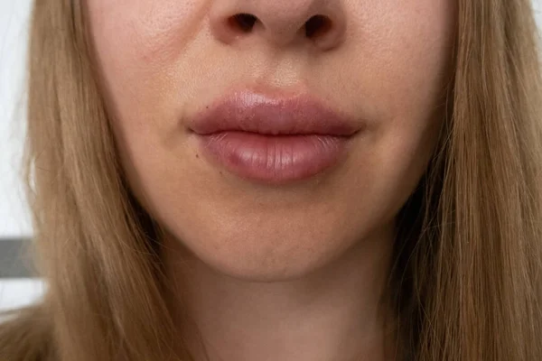 woman lips close up view after lip augmentation procedure with fillers, increase lips hyaluronic acid, visible place of needle injection marks, swelling after cosmetic procedure, cosmetician treatment