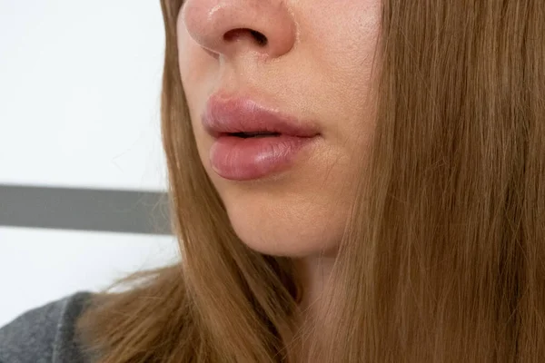 Vrouw Lippen Close Zicht Lip Vergroting Procedure Met Vulstoffen Verhoging — Stockfoto
