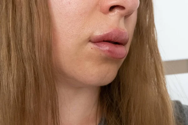 Γυναικεία Χείλη Close Προβολή Μετά Διαδικασία Αύξησης Των Χειλιών Γεμιστικά — Φωτογραφία Αρχείου
