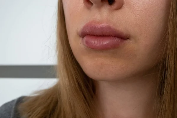 Labios Mujer Cerrar Vista Después Del Procedimiento Aumento Labios Con —  Fotos de Stock