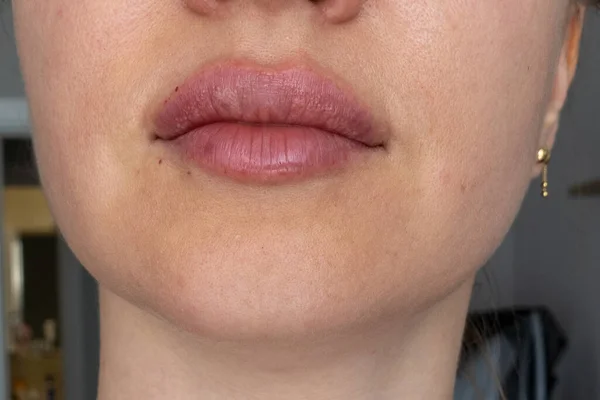 woman lips close up view after lip augmentation procedure with fillers, increase lips hyaluronic acid, visible place of needle injection marks, swelling after cosmetic procedure, cosmetician treatment