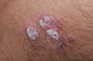 Dermatit ve sedef hastalığından kaynaklanan sedef hastalığı lezyonları.