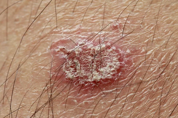 皮膚炎や乾癬による乾癬の病変 — ストック写真