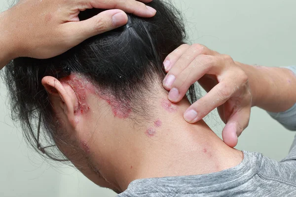 Las Enfermedades Del Sistema Inmunitario Causan Psoriasis —  Fotos de Stock