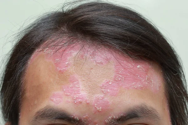 Diseases Immune System Cause Psoriasis — ストック写真