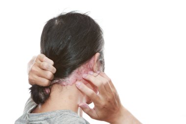 Psoriasis caused by a weakened immune system.