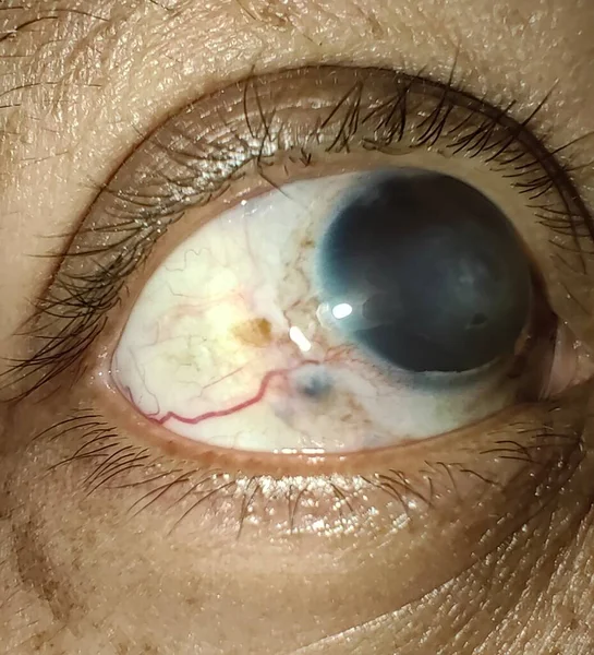 Olhos Doloridos Olhos Inchados Glaucoma — Fotografia de Stock
