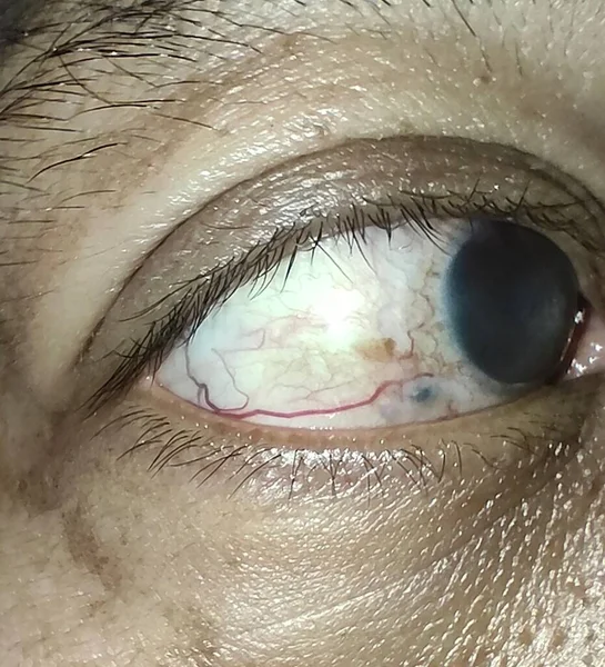 Wunde Augen Geschwollene Augen Glaukom — Stockfoto