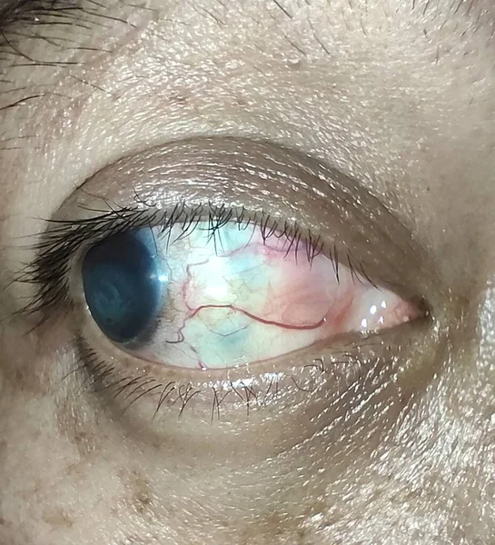Болісні Очі Опухлі Очі Глаукома — стокове фото