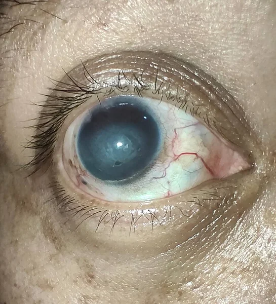 Olhos Doloridos Olhos Inchados Glaucoma — Fotografia de Stock