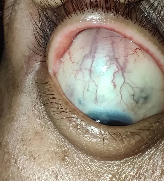 Olhos Doloridos Olhos Inchados Glaucoma — Fotografia de Stock