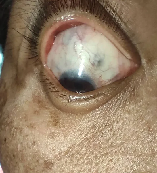 Olhos Inchados Glaucoma Vermelho Pus — Fotografia de Stock