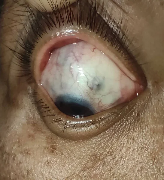 Olhos Inchados Glaucoma Vermelho Pus — Fotografia de Stock