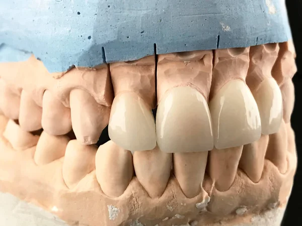 Dental zirconia crowns in the plaster model. Closeup of dental prosthesis porcelain teeth in a mold. Dental clinic.