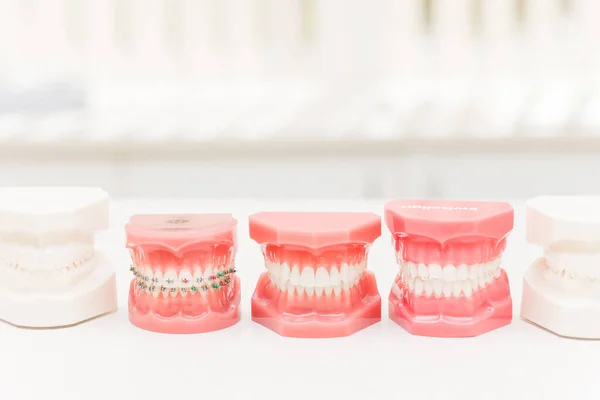 一套五颗牙齿模型 显示不同的牙齿矫正装置 — 图库照片
