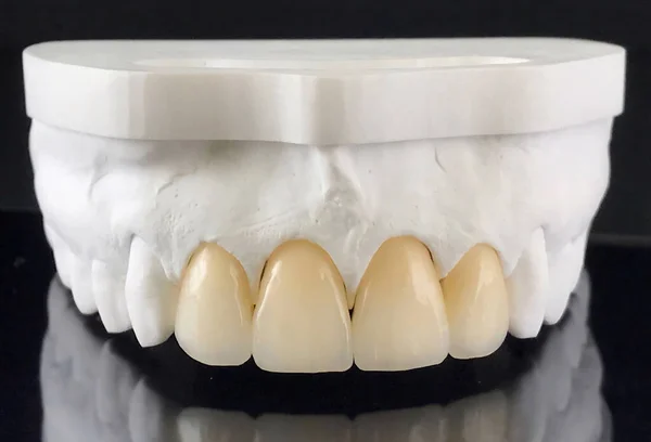 Restoration of teeth on the upper jaw. Production of dental veneers in a dental laboratory. veneers with all ceramic porcelain