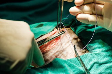 A closeup shot of a hand with a medical glove making stitches on a patient belly during a surgery