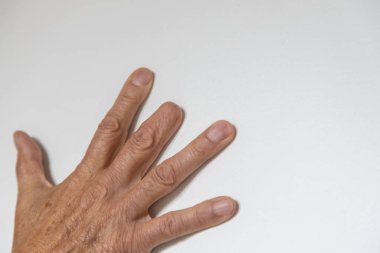 Elderly man right hand with amputated middle finger on white background
