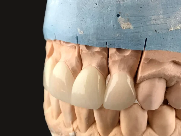 Натисніть Керамічні Коронки Вініри Одного Кольору Реставрація Зубів Стоматологічна Лабораторія — стокове фото
