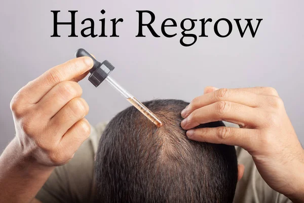 Man with a dropper apply hair oil on the bald area for hair growth in white background.