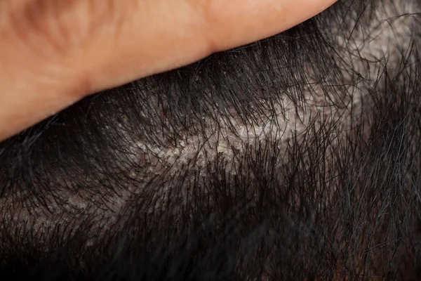 Man Showing Dandruff Problem Flaking Scalp Due Seborrheic Dermatitis Fungal — Stock Photo, Image