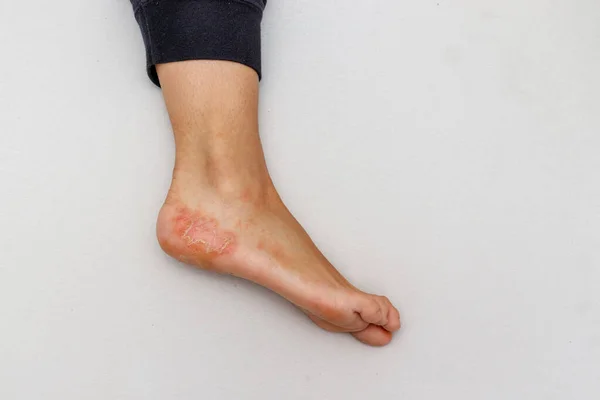 Dyshidrotic Eczema Skin Disease Foot Heel White Background — Stock Photo, Image