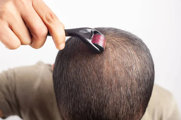 collagen induction therapy, Using dermaroller on bald area improve hair regrowth. guy using Microneedling on head for Androgenetic alopecia