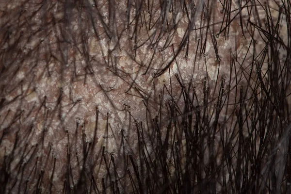 Dry Flaky Scalp Dandruff Problem Psoriasis Asian Man Have Flaking — Stock fotografie