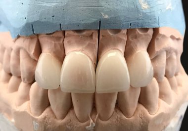 Artificial jaw with a ceramic crown on implants, stands on a surgical glass in a stomatologic office. Dentistry and treatment concept